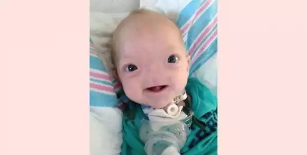 ‘Miracle Baby’ Born Without A Nose Dies At The Age Of Two Graphic Photos